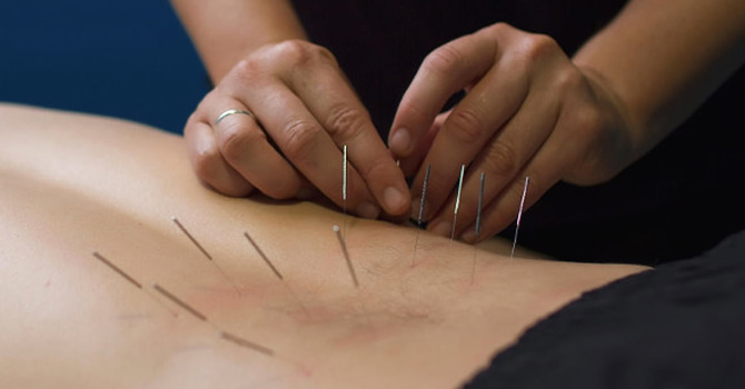 Dry Needling of Myofascial Trigger Points