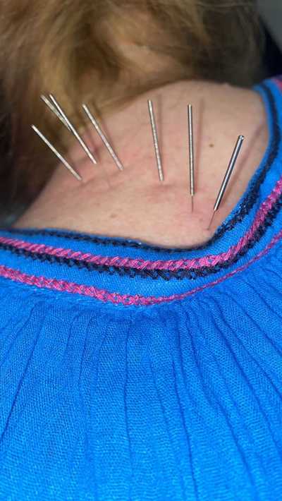 dry needling near me, dry needling st peters, saint peters dry needling