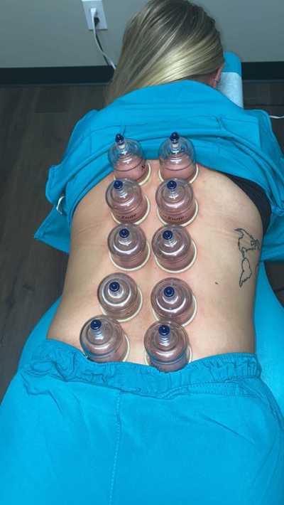 cupping near me, cupping st peters, saint peters cupping